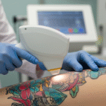 A Fórmula do Preço: Os Fatores que Definem o Valor da Remoção de Tatuagem