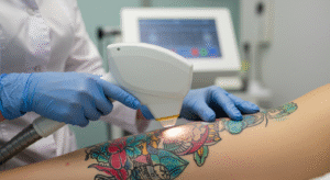 Profissional realizando um procedimento de remoção de tatuagem a laser, ilustrando o processo e o valor envolvido.